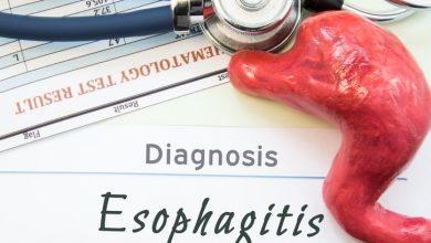 La esofagitis eosinofílica es una afección inflamatoria crónica del esófago, caracterizada por la acumulación de un tipo específico de glóbulo blanco, los eosinófilos, en la mucosa esofágica.