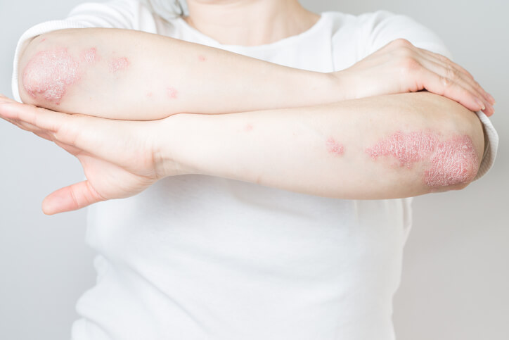 Taltz (ixekizumab) demuestra eficacia a largo plazo en pacientes con psoriasis y artritis psoriásica