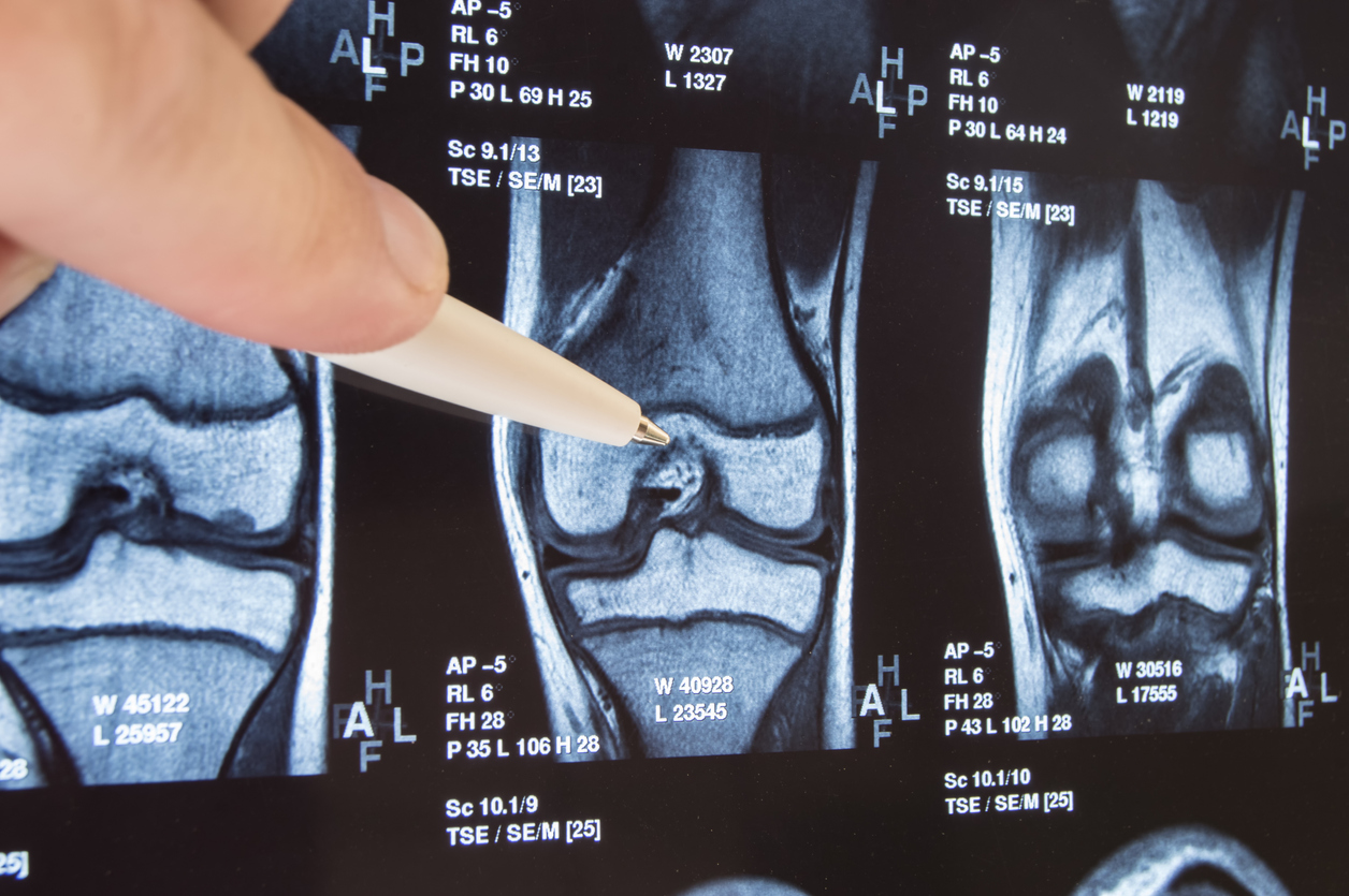 ¿Qué diferencia la artritis reumatoide de la osteoartritis?