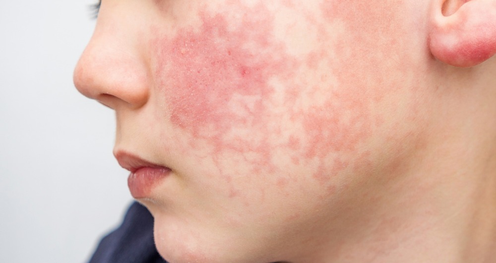 Dermatitis atópica todo lo que debes saber BeHealth