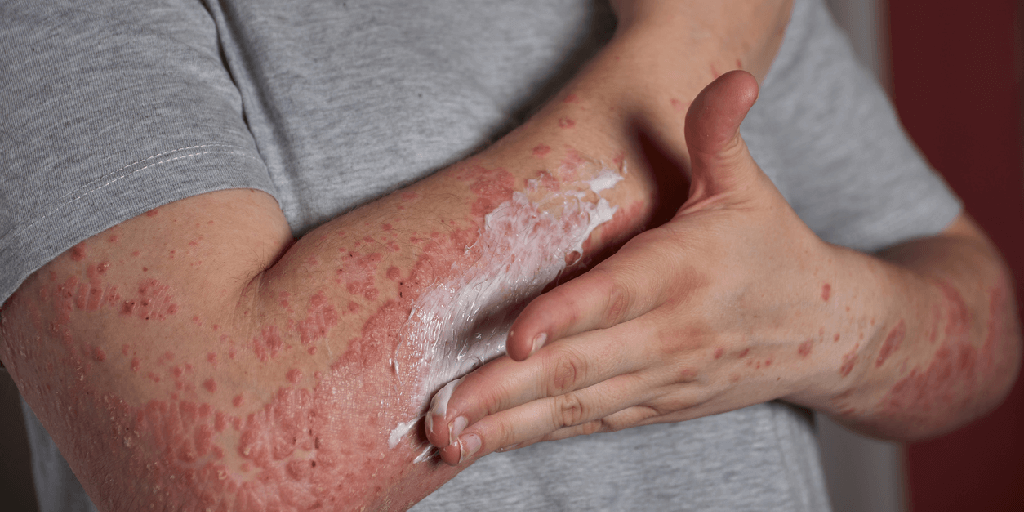 Con grupos de apoyo buscan hacerle frente a la Psoriasis