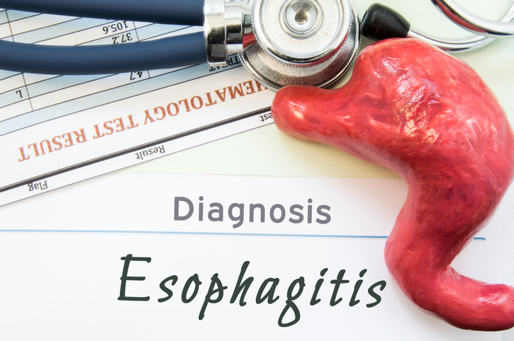 La esofagitis eosinofílica es una afección inflamatoria crónica del esófago, caracterizada por la acumulación de un tipo específico de glóbulo blanco, los eosinófilos, en la mucosa esofágica.