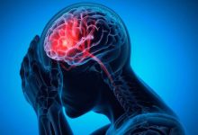 Accidente cerebrovascular: conoce las nuevas recomendaciones para prevenirlos