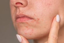 Dermatitis perioral, ¿ya conociste a diferenciarla?