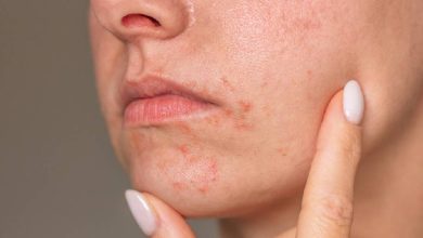 Dermatitis perioral, ¿ya conociste a diferenciarla?