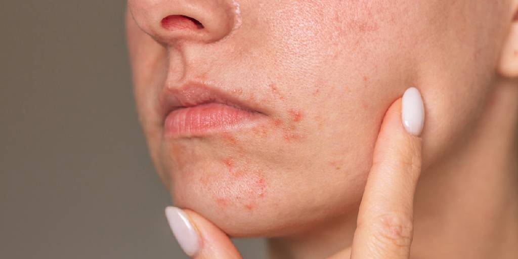 Dermatitis perioral, ¿ya conociste a diferenciarla?