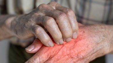 La lepra es una enfermedad infecciosa crónica causada por la bacteria Mycobacterium leprae.